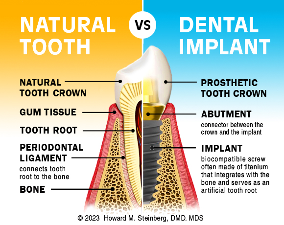 Dental implant compared to natural tooth.