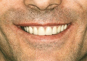 A patient with a beautiful smile after receiving dental implant bridges.