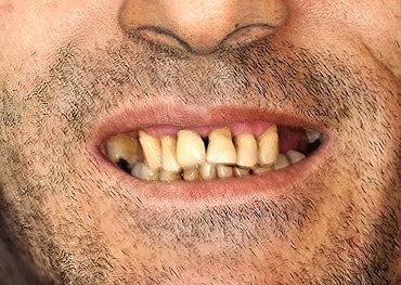 A patient before receiving dental implants.