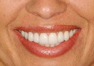 The same patient’s beautiful new smile with porcelain veneers.