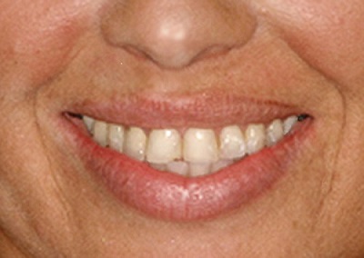 A photo of a patient’s teeth before porcelain veneers, with chips to front teeth.