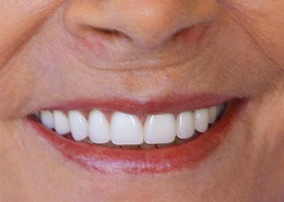 The same patient after Teeth-in-a-Day, with a beautiful, natural-looking smile