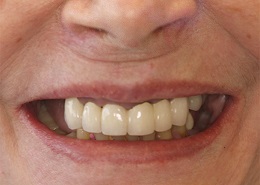 A patient before Teeth-in-a-Day, with previous dental work that looks fake.