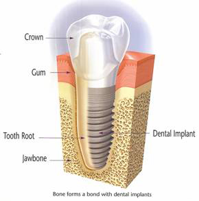 An illustrated diagram of a cross-section of a dental implant, with labels.