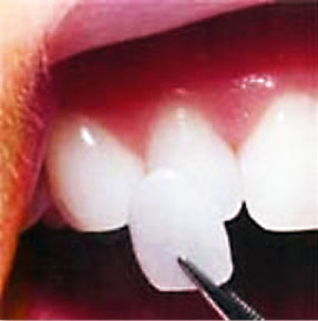 A wafer-thin porcelain veneer being placed on a tooth.