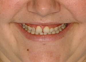 A close-up of a woman's mouth, showing her gummy smile and small teeth, prior to cosmetic dentist smile design.