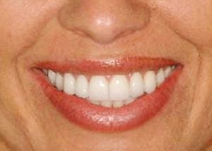 A close-up of a woman's mouth. Cosmetic dentist Dr. Steinberg has given her a whiter smile with larger, more symmetrical teeth.