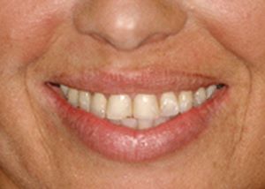A close-up of a patient's smile before cosmetic dentist smile restoration. Her teeth are chipped.