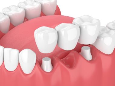 an illustration of a bridge consisting of three porcelain crowns being placed over two implants