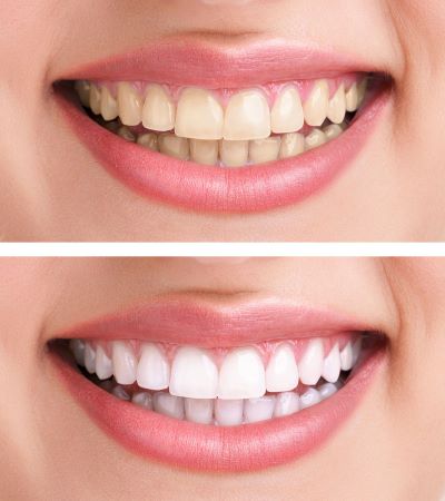 Images of a woman's smile before and after teeth whitening. In the before image, her teeth are yellow. In the after image, they are white