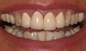 A close-up of a patient's mouth. The PFM crowns are distinctly opaque and look fake.