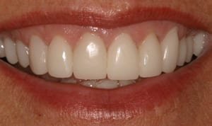The same smile restored with all-ceramic crowns.