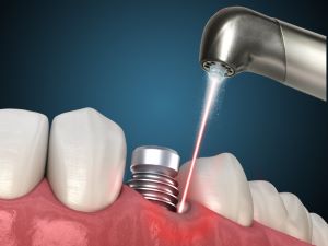 an illustration of saving a dental implant with laser implant therapy