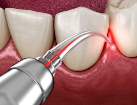 image of laser dentistry showing removal of gum tissue
