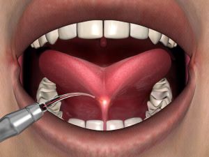 an illustration of a laser frenectomy