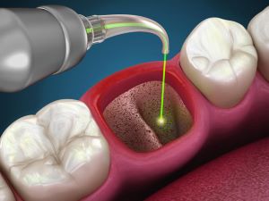 an illustration of laser socket disinfection showing one empty socket in a row of healthy teeth