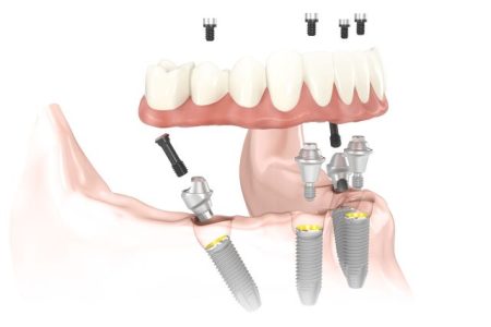 an illustration showing how All-on-4 dentures are held in place by four implants
