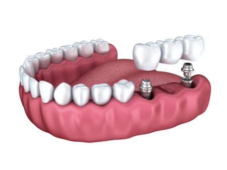 An illustration of a lower arch of teeth with an implant bridge