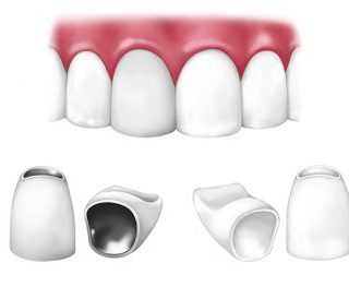 an illustration of an arch of teeth and two different crowns -- one all-porcelain and one porcelain-fused-to-metal