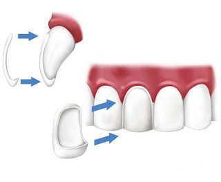 an illustration of a wafer-thin dental veneer showing how it is placed on the tooth