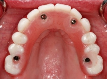 photo of a fixed hybrid implant denture, showing the upper teeth, with four screws to attach it to the implants.