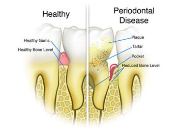 An illustration showing a tooth. One side of the tooth is healthy. The other has periodontal disease.