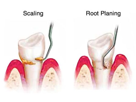 an illustration comparing two teeth -- one with scaling and one with root planing