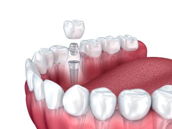 an illustration of a healthy lower arch of teeth. One tooth has been replaced with a post, an abutment, and a crown. This comprises a single dental implant.