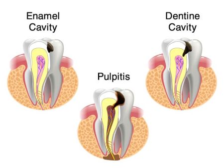 an illustration of three teeth, each with a different problem: enamel cavity, pulpitis, and dentine cavity
