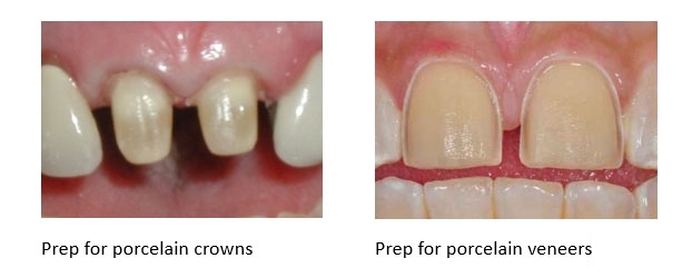 A side by side comparison of tooth preparation for dental crowns as well as porcelain veneers