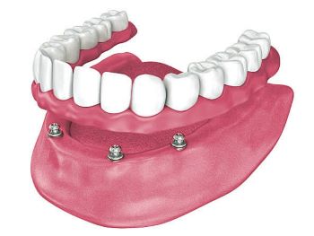 snap on overdentures