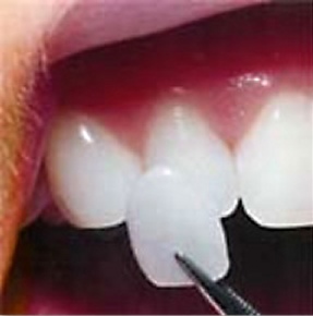 A porcelain veneer being held up to a tooth
