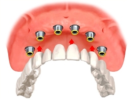 Upper denture